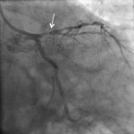 Coronariografia: arteria coronária (descendente anterior) com lesão proximal em doente com enfarte do miocardio Imagem cedida pelo Dr. Luis Raposo (Hospital Santa Cruz)